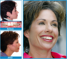 Damon™ Smile Info