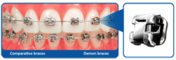Damon Smile facilitates healthy tooth movement