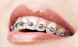 Self-ligating braces