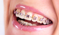 Traditional metal braces